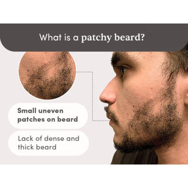 Man Matters Beardmax Growth Serum 30ml | 5% Minoxidil | Activates Beard Follicles | Solves Uneven & Patchy Beard | Alcohol Free